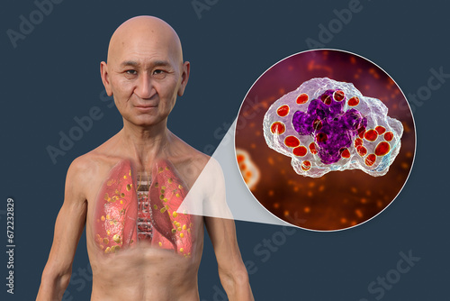 Lung histoplasmosis, a fungal infection caused by Histoplasma capsulatum, 3D illustration photo