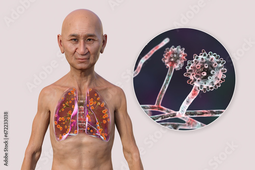 Lung histoplasmosis, a fungal infection caused by Histoplasma capsulatum, 3D illustration photo