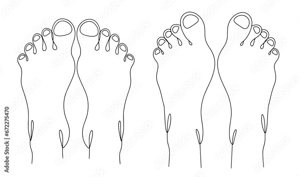 Valgus deformity of the foot. One line - obrazy, fototapety, plakaty 