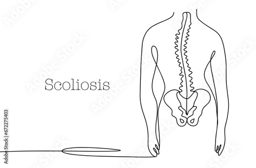 Scoliosis. Human. Spine. Rachiocampsis. One line