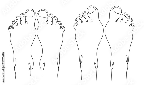 Valgus deformity of the foot. One line