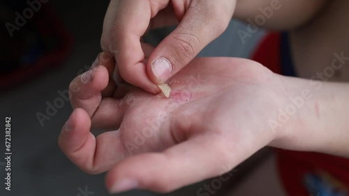 touches a callus on his palm from hard work. Street workout, torn skin on my palm.