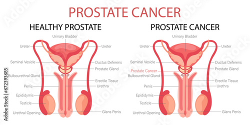 Prostate cancer. Male reproductive system. Anatomy of the internal organs of man. Infographic banner, diagram, vector