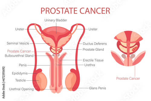 Prostate cancer. Male reproductive system. Anatomy of the internal organs of man. Infographic banner, diagram, vector