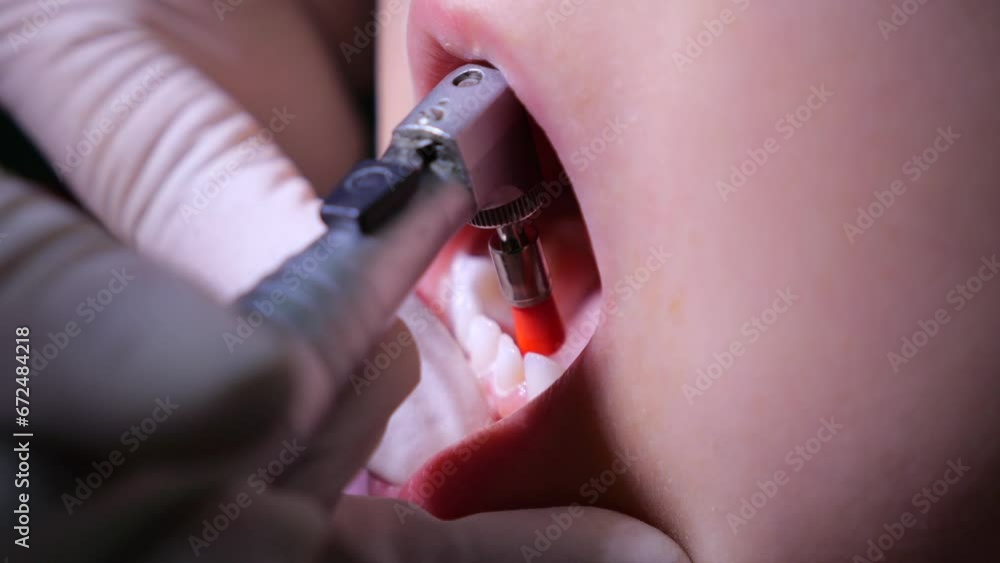 Kid with open mouth during teeth polishing procedure at pediatric dentist. Dentist gently holds childs lip, gently polishes inside of teeth with dental drill. Concept calm teeth polishing at dentist Kid with open mouth during teeth polishing procedure at pediatric dentist. Dentist gently holds childs lip, gently polishes inside of teeth with dental drill. Concept calm teeth polishing at dentist
