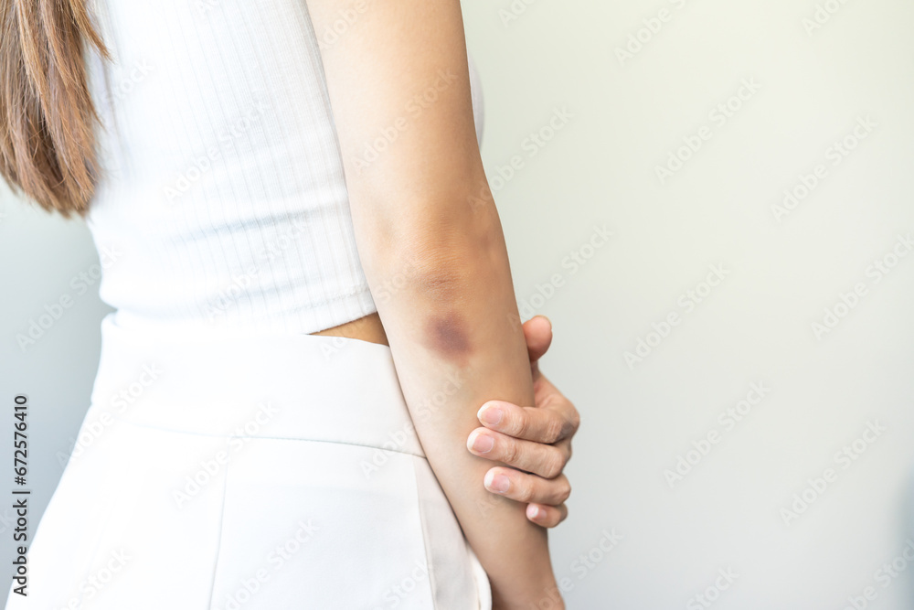 Close up of stain bruise wound on her elbow, contusion asian young