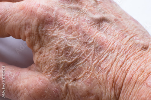 Close up of the wrinkled skin on the hand of an older man with some lesions of actinic keratosis or sunspots