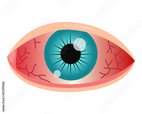 red eye conjunctivitis. vector illustration