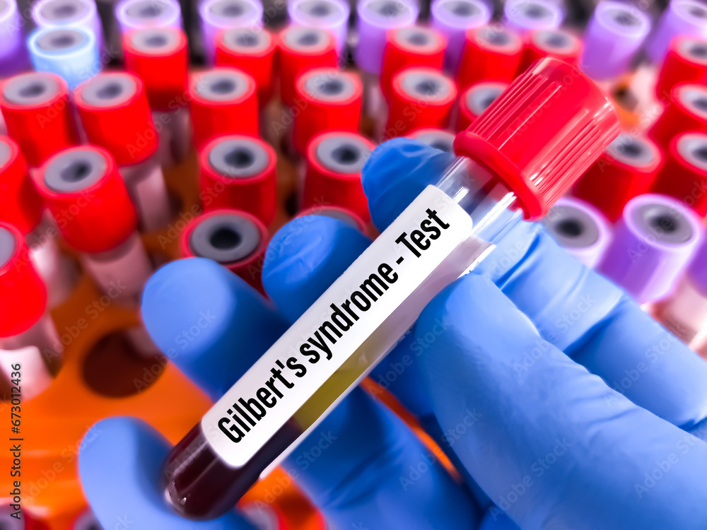Obraz premium Blood sample for Gilbert Syndrome testing at medical laboratory.