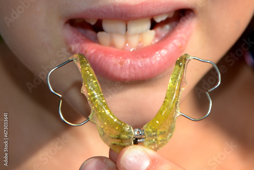 Teenager wearing orthodontic appliance dental treatment to improving bite gap. photo