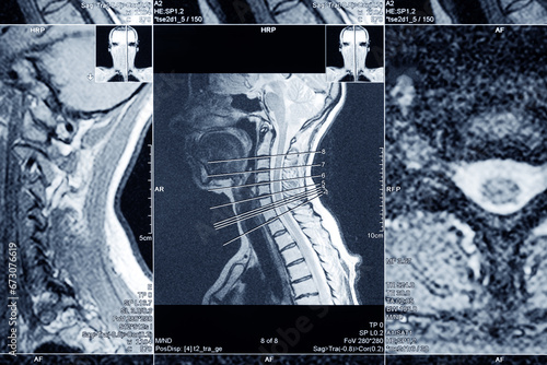 MRI scan of the cervical spine for diagnosis. Medical examination photo