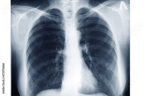 photo X-ray scan of the chest area. Lung radiography photo