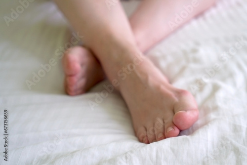 female legs with problem with women's feet, bunion toes in bare feet. Hallus valgus, photo