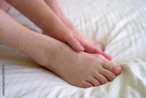 female legs with problem with women's feet, bunion toes in bare feet. Hallus valgus, photo