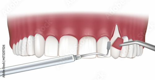 Foto Gum Recession Treatments