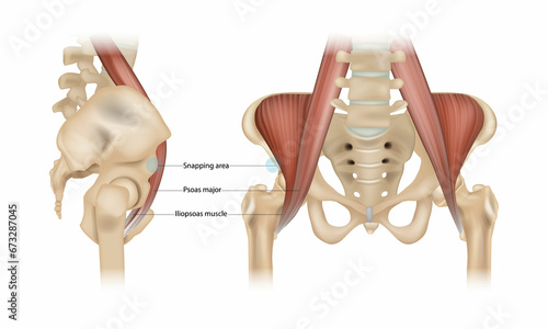 Fényképezés Internal snapping hip Syndrome