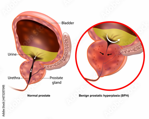Medical illustration showing Benign prostatic hyperplasia BPH and Normal prostate. Prostate gland enlargement photo