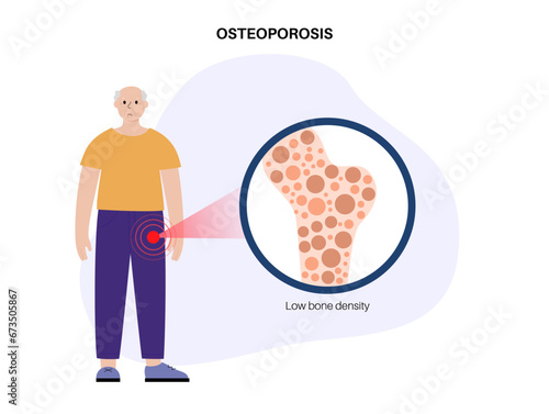 Osteoporosis medical poster