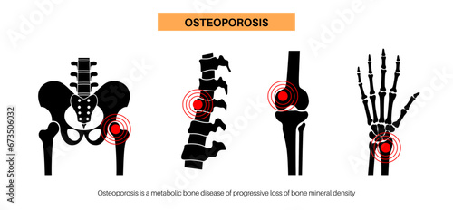 Osteoporosis medical poster