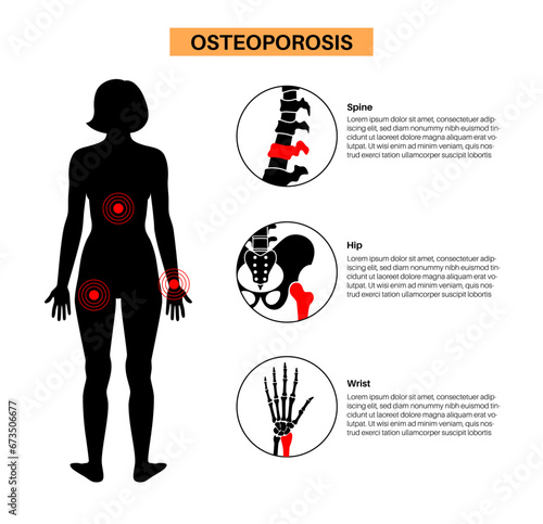 Osteoporosis medical poster