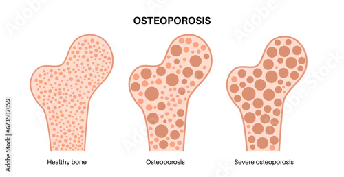Osteoporosis medical poster