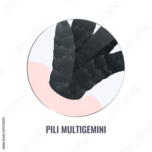 Pili multigemini hair disorder surface under microscope. Multiple hair shafts ingrowth condition closeup vector. Trichology medical concept.