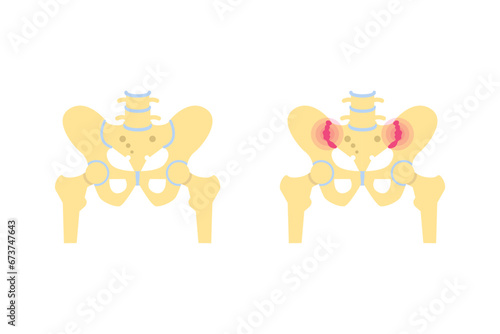 Sacroiliac joint inflammation. Vector medical illustration.