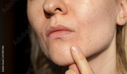 The woman skin flakes off at the mouth. Dry skin. Face skin irritation after peeling, after cold windy weather. Dark background, view by profile. She is showing the problem with the finger. photo