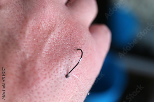 Man's Hand with Fish Hook Stuck Inside Skin