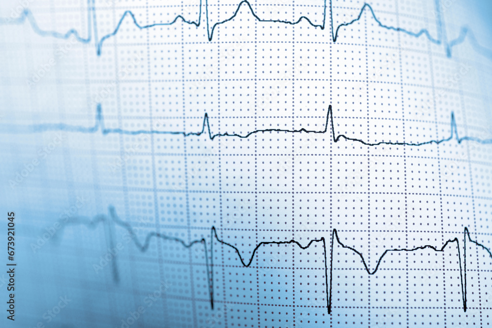 Close-up of an electrocardiogram printed on blue paper. Close-up of an electrocardiogram printed on blue paper.