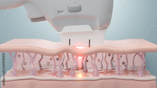 Ultherapy or HIFU treatment shot laser to SMAS to lift and tighten skin, Blue science background. 3D rendering.