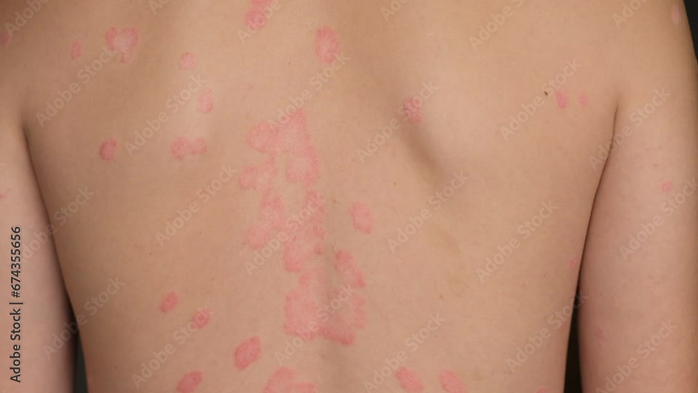 Psoriasis Vulgaris, skin patches are typically red, itchy, and scaly. Papules of chronic psoriasis vulgaris on male hand, back and body. Genetic immune disease. Detail of psoriatic skin disease Psoriasis Vulgaris, skin patches are typically red, itchy, and scaly. Papules of chronic psoriasis vulgaris on male hand, back and body. Genetic immune disease. Detail of psoriatic skin disease
