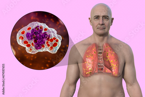 Lung histoplasmosis, a fungal infection caused by Histoplasma capsulatum, 3D illustration photo