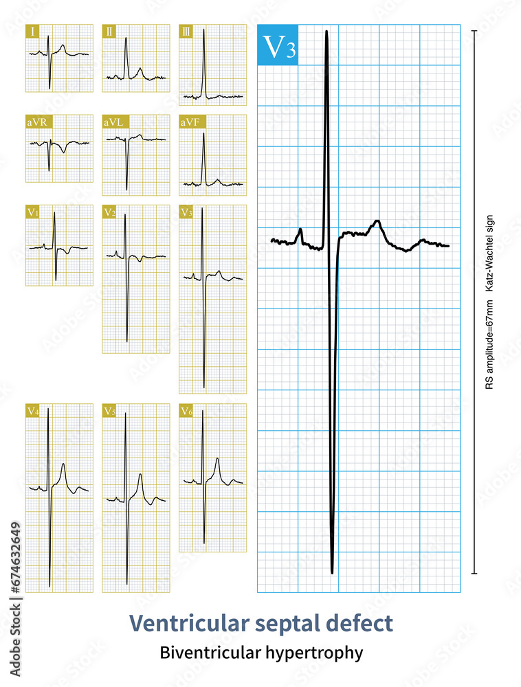 A 19-year-old young man suffering from ventricular septal defect has developed secondary pulmonary hypertension, and his electrocardiogram indicates biventricular hypertrophy.