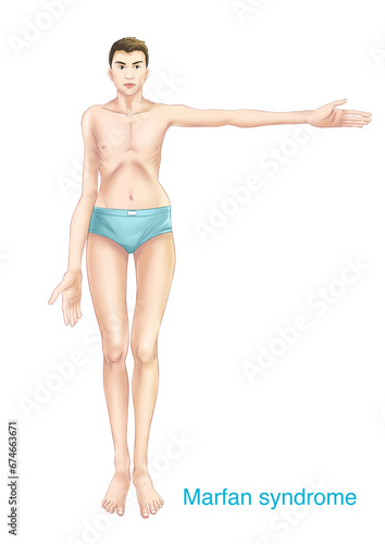 Marfan syndrome is an autosomal dominant connective tissue disease characterized by elongated limbs, cardiovascular system abnormalities, and sudden death.