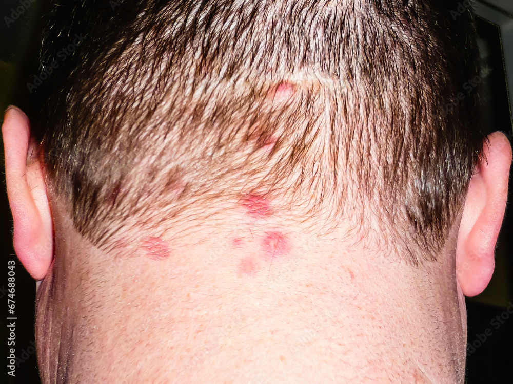 Dermatitis Herpetiformis, a rare skin condition suffered by people with Coeliac Disease. The sores are very itchy and burn. Dermatitis Herpetiformis, a rare skin condition suffered by people with Coeliac Disease. The sores are very itchy and burn.