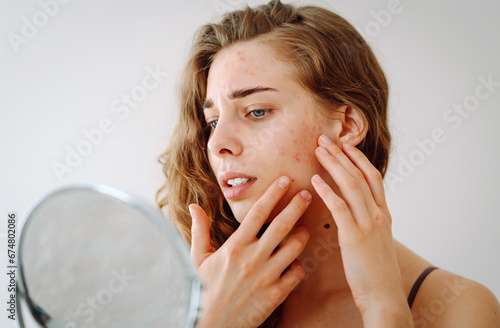 Dermatology. A beautiful woman looking in the mirror, touching her face with her hand, examines acne, pigmentation. Cosmetic care. Allergic reaction. Health concept, cosmetology. photo