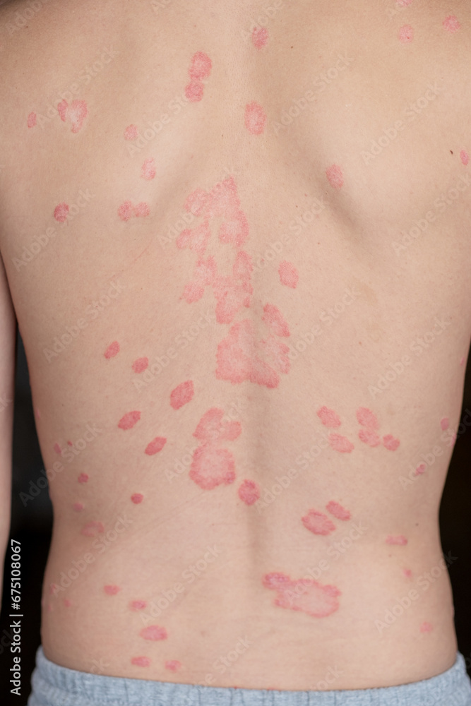 Psoriasis Vulgaris, skin patches are typically red, itchy, and scaly. Papules of chronic psoriasis vulgaris on male hand, back and body. Genetic immune disease. Detail of psoriatic skin disease Psoriasis Vulgaris, skin patches are typically red, itchy, and scaly. Papules of chronic psoriasis vulgaris on male hand, back and body. Genetic immune disease. Detail of psoriatic skin disease