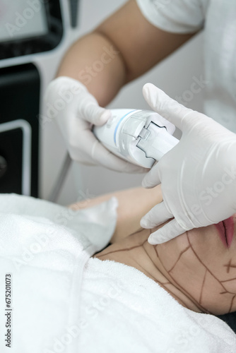 Close up of a patient receiving HIFU therapy-high intensity focused ultrasound treatment on face. Therapist doing non-surgical cosmetic plasma lift on client cheek with ultrasonic device. SMAS lifting