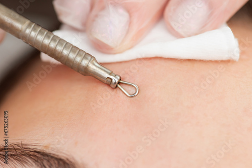 Deep cleaning of the female face with blackhead remover in the beauty salon, close up. Using steel tool for cleaning skin from blackheads and acne by cosmetologist