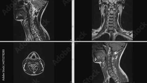 MRI scans of the cervical spine human body. Examining and identifying health problems with magnetic resonance imaging photo