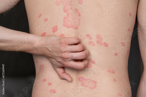 Wallpaper Mural Psoriasis Vulgaris, skin patches are typically red, itchy, and scaly. Papules of chronic psoriasis vulgaris on male hand, back and body. Genetic immune disease. Detail of psoriatic skin disease  Torontodigital.ca