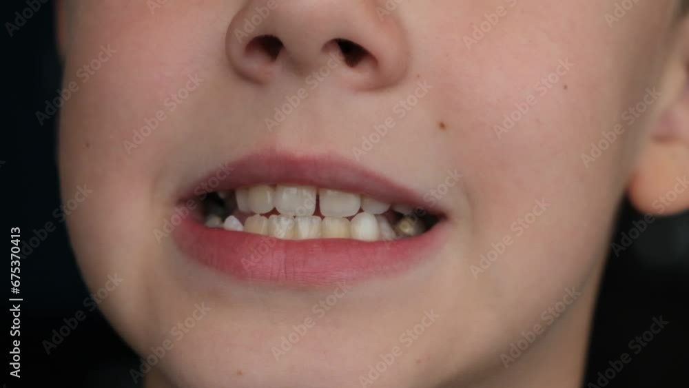 Child's crooked teeth. Young man showing crooked growing teeth. The child needs to go to the dentist to install braces. Child's crooked teeth. Young man showing crooked growing teeth. The child needs to go to the dentist to install braces.