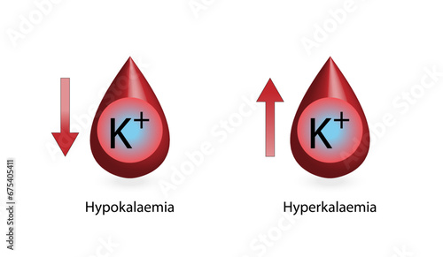 	
Hyperkalaemia, high plasma potassium level and Hypokalaemia, low plasma potassium level. Potassium K excess and deficit electrolyte disorders, blood test tube, Scientific design. Vector illustration