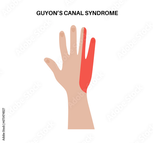 Guyons canal syndrome