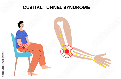 Cubital tunnel syndrome