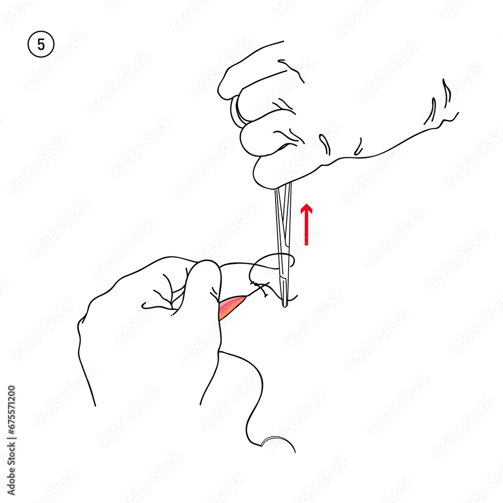 No 5, Simple Suture Techniques Stitching, Incision and Laceration