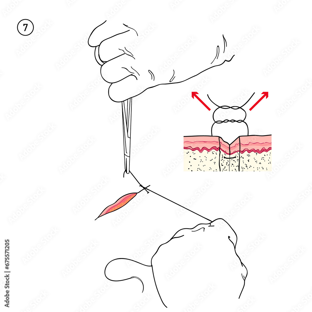 No 7, Simple Suture Techniques Stitching, Incision and Laceration