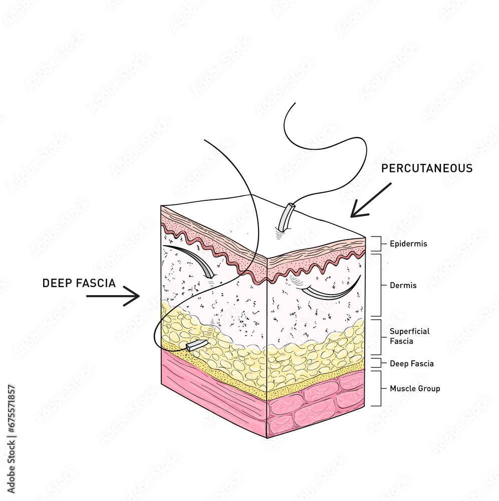 Simple Suture Techniques Stitching, Incision and Laceration Stitching
