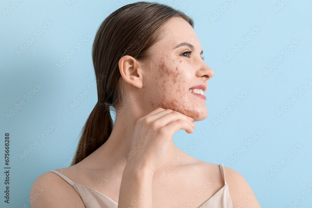 Young woman with acne problem on blue background, closeup Young woman with acne problem on blue background, closeup